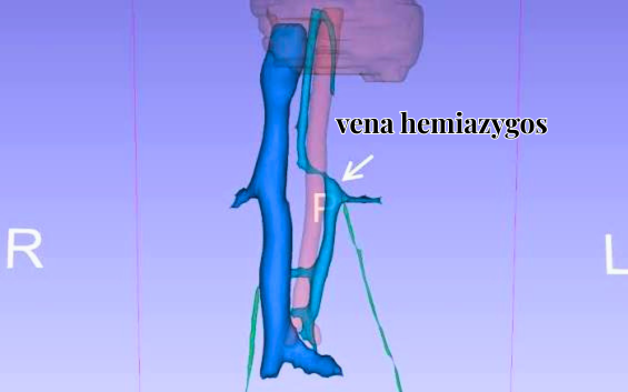 Vena Hemiazygos (Hemiazygos Vene) Anatomie Funktion und klinische Bedeutung carls musikcafe seifhennersdorf